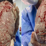 Mãe engravida com DIU e bebê nasce com dispositivo no corpo