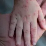 Exame descarta caso de Mpox em aluno de Cabo Frio; criança estava com catapora